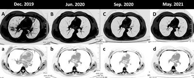 Case Report: Patient With Lung Adenocarcinoma With ALK-HLA-DRB1 Rearrangement Shows Impressive Progression-Free Survival After Sequential Crizotinib and Ceritinib Treatment